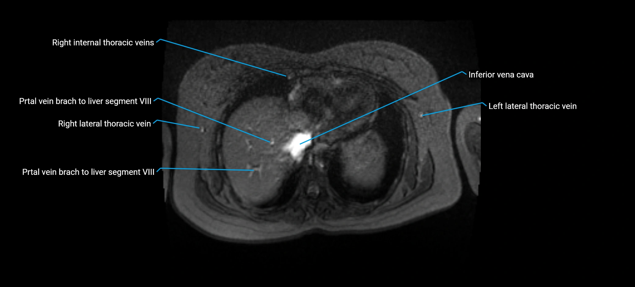 MRV abdomen pelvis & lower limb axial cross sectional anatomy labelled MRI image 15 (1).webp
